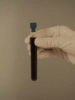 Santé Clinic Vancouver Treatment Process - Preparation (1)